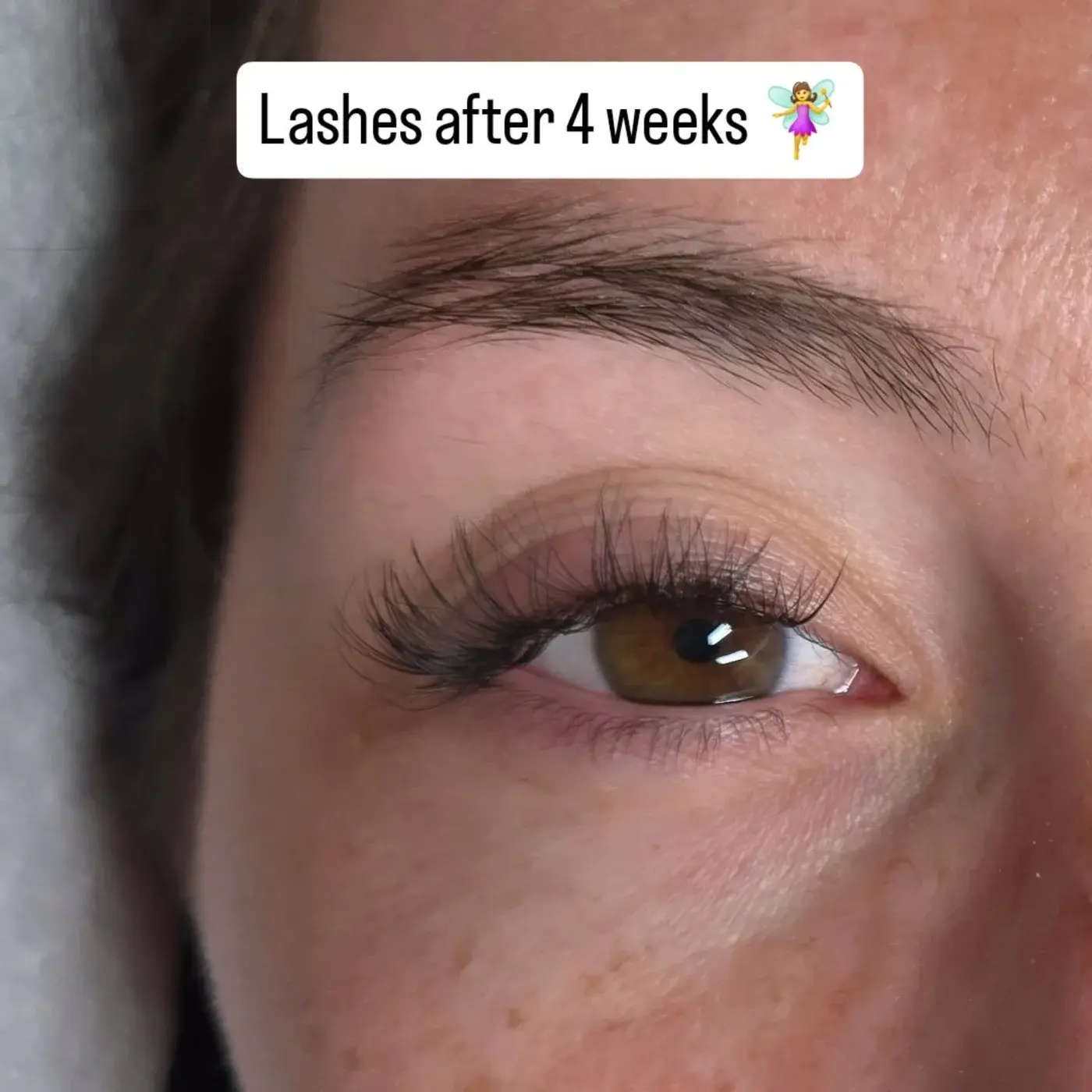 Soft volume touch-up photographed before and after